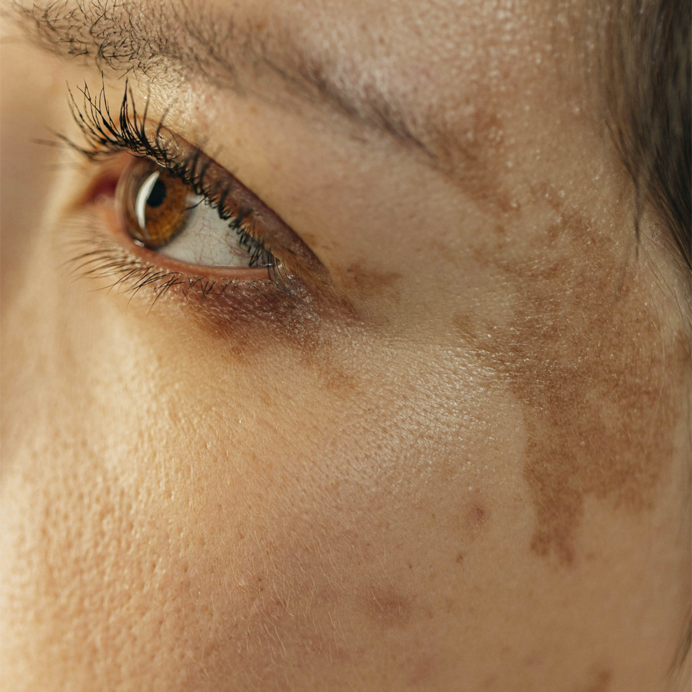 Pigmentation & Tanning